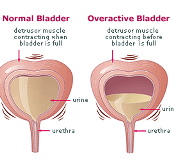 Bladder Diseases, Causes, Treatment