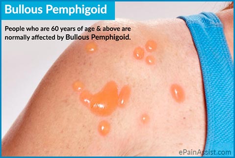 Bullus Pemphigoid