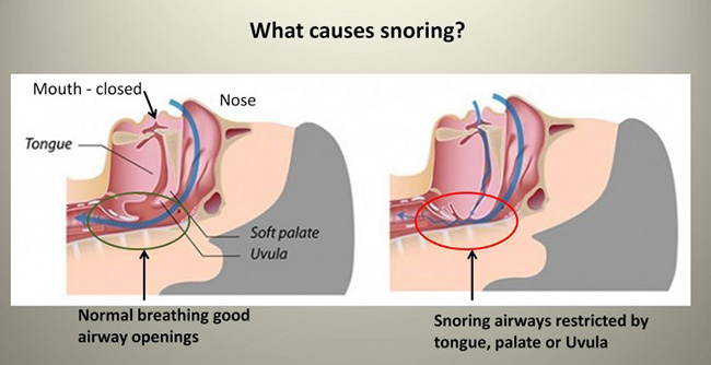Causes of Snoring and How to Stop it Naturally